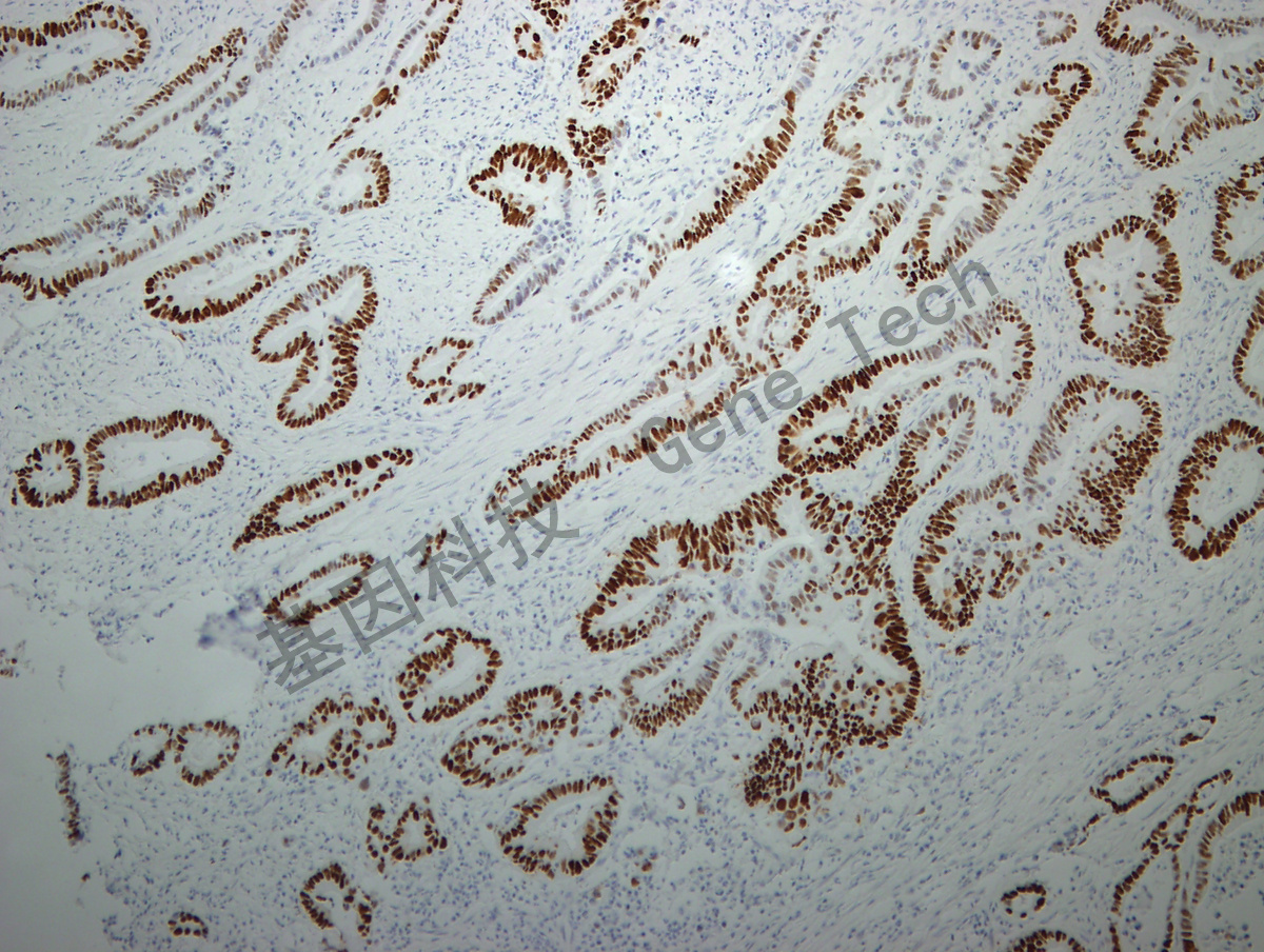 p53 GM7001结肠癌 10X.jpg