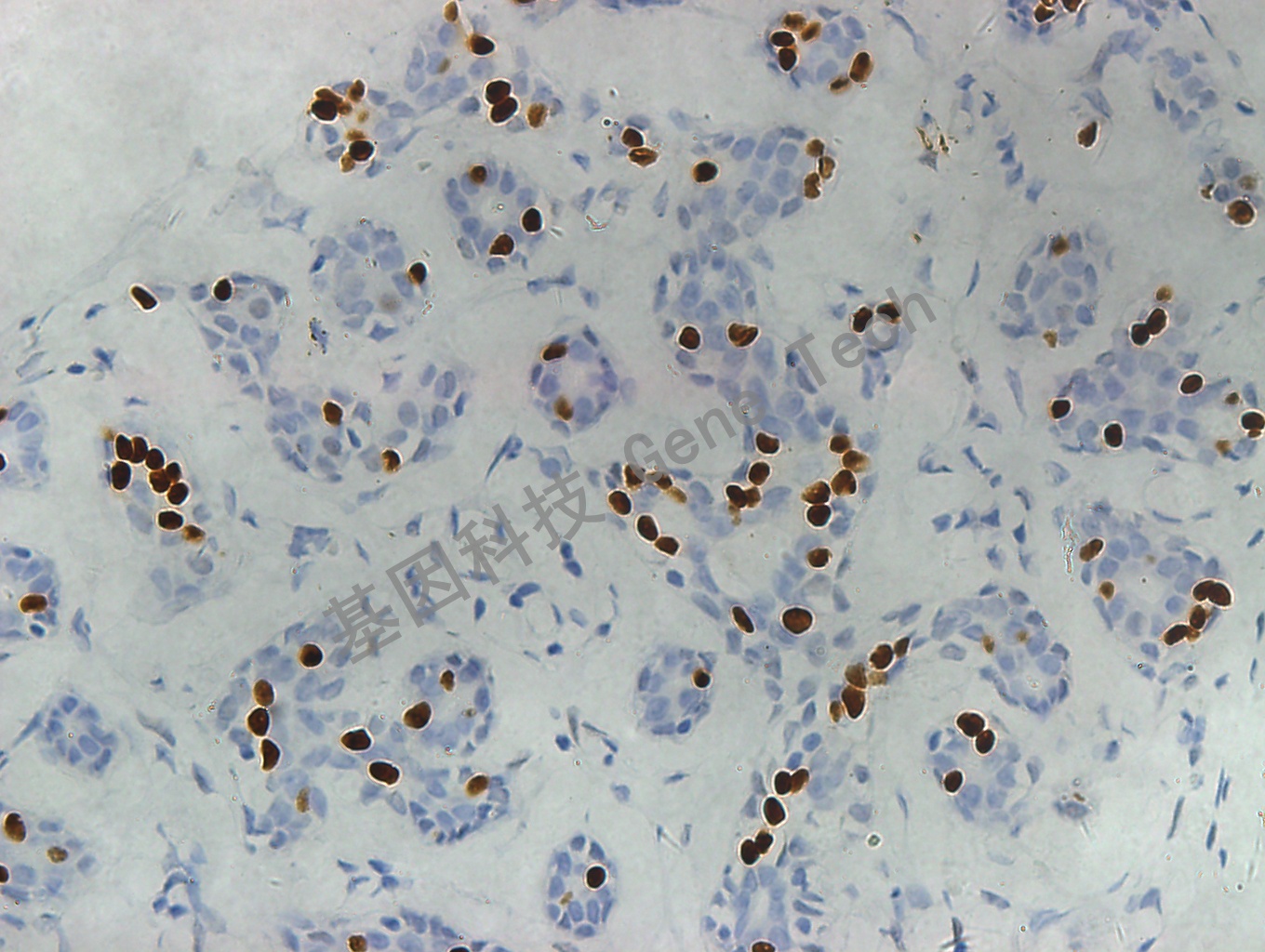 PR GT2057 乳腺癌3_副本.jpg