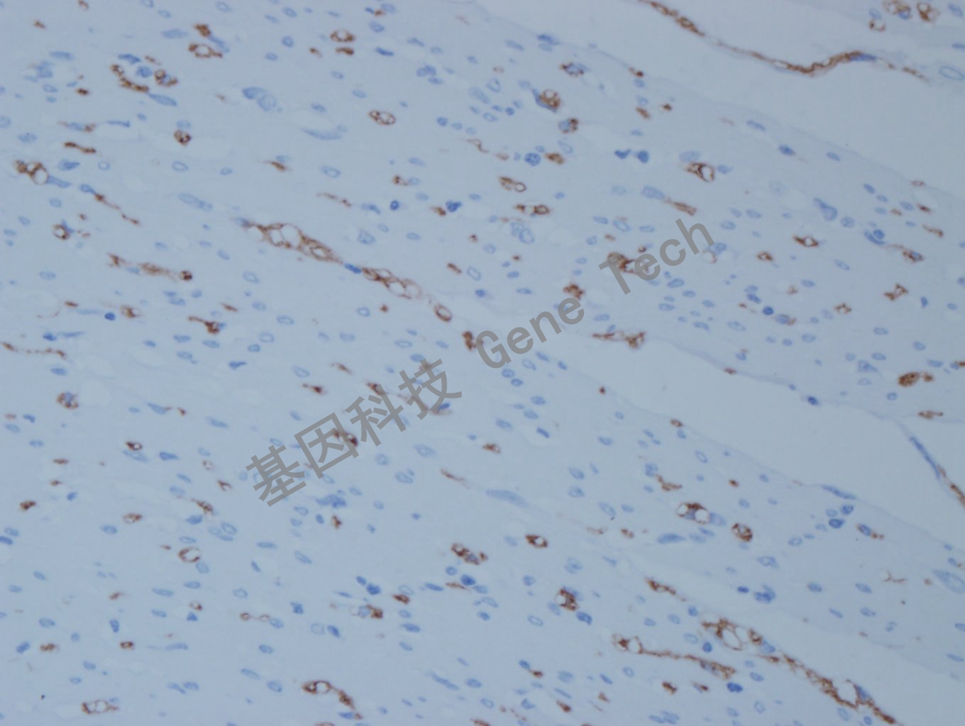 20200922-12 L1CAM F47 结肠癌-6_副本.jpg