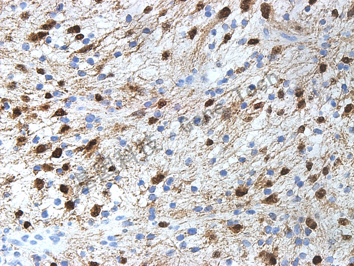 s100抗体试剂(免疫组织化学)多克隆兔抗人多克隆