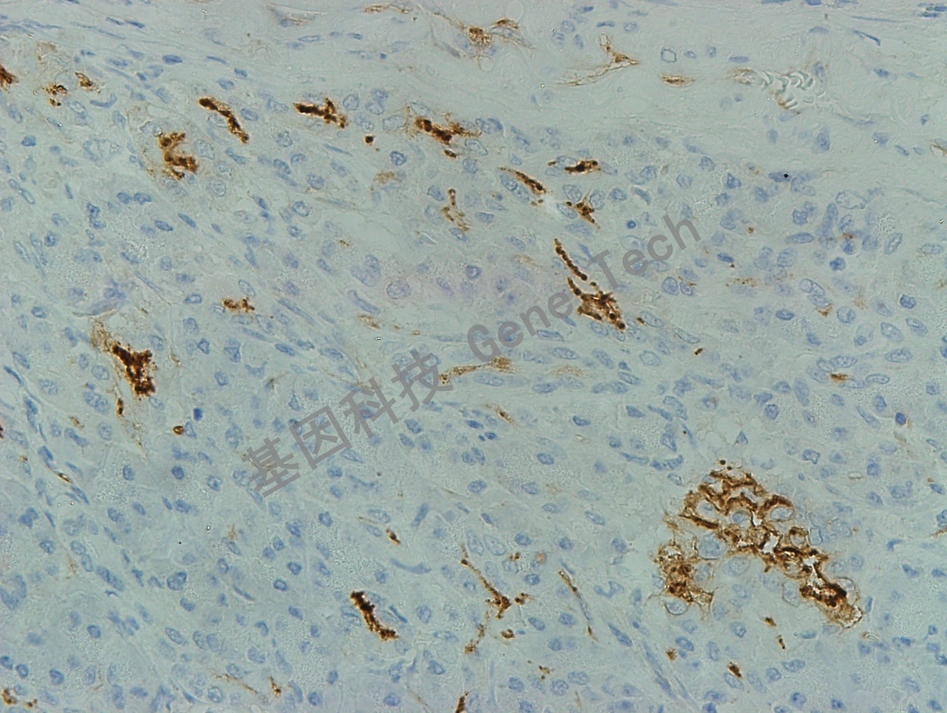 CD54 GT2254 胰腺癌 40X_副本.jpg