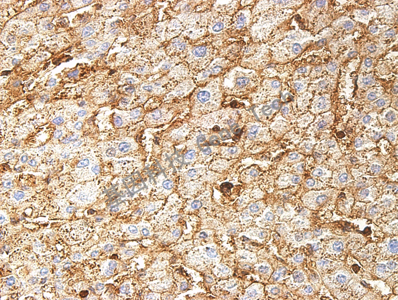 CD99 GT2123 肝癌 40X_副本.jpg