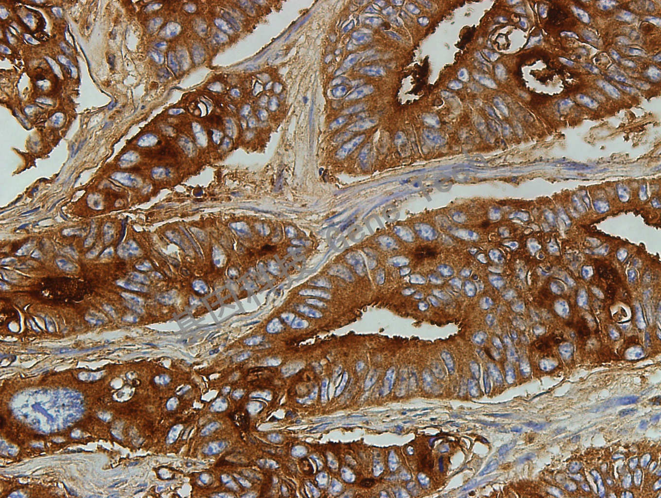 CEA 40X 结肠癌_副本.jpg