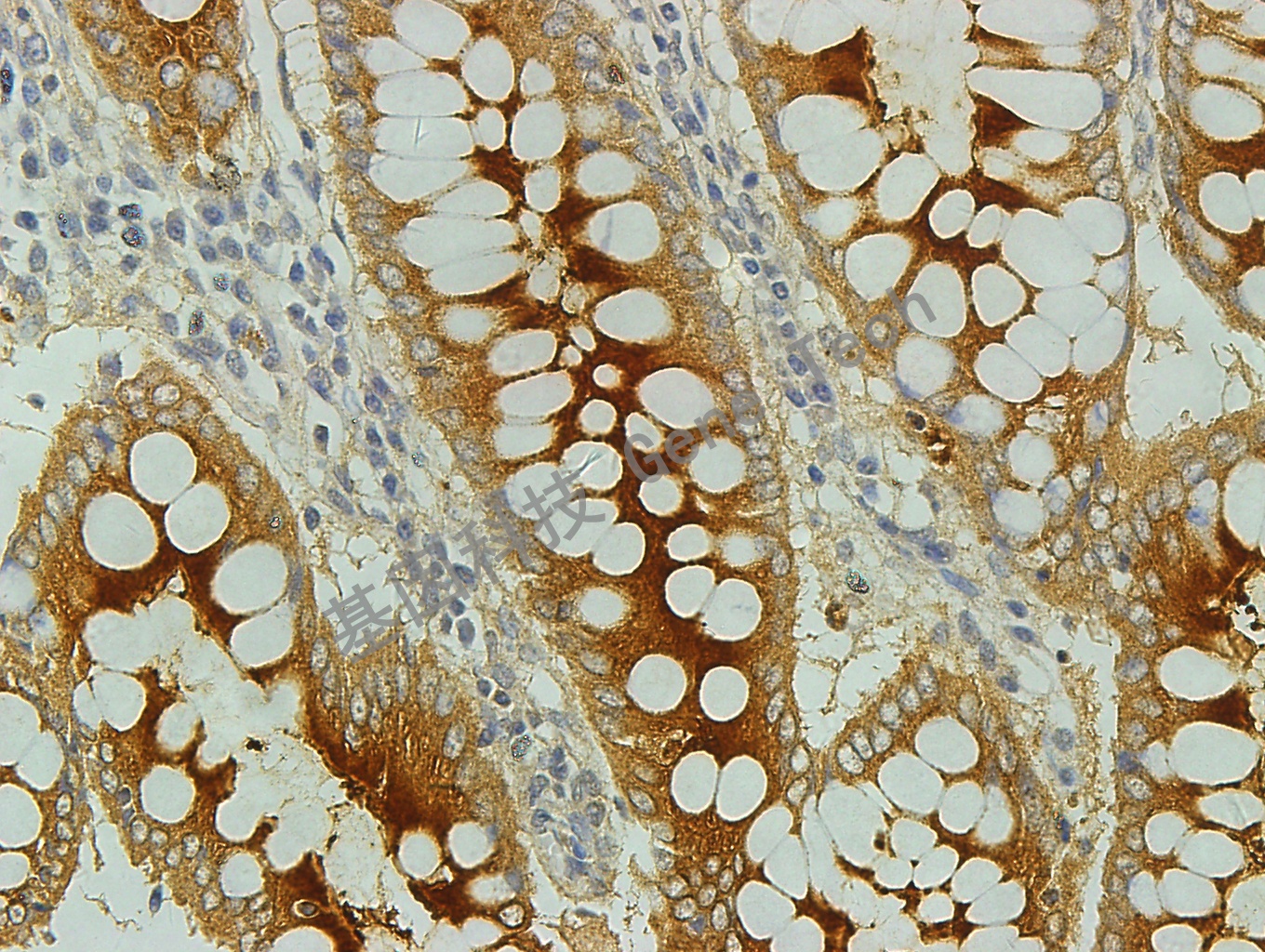 CEA GT2107 结肠癌 40X_副本.jpg