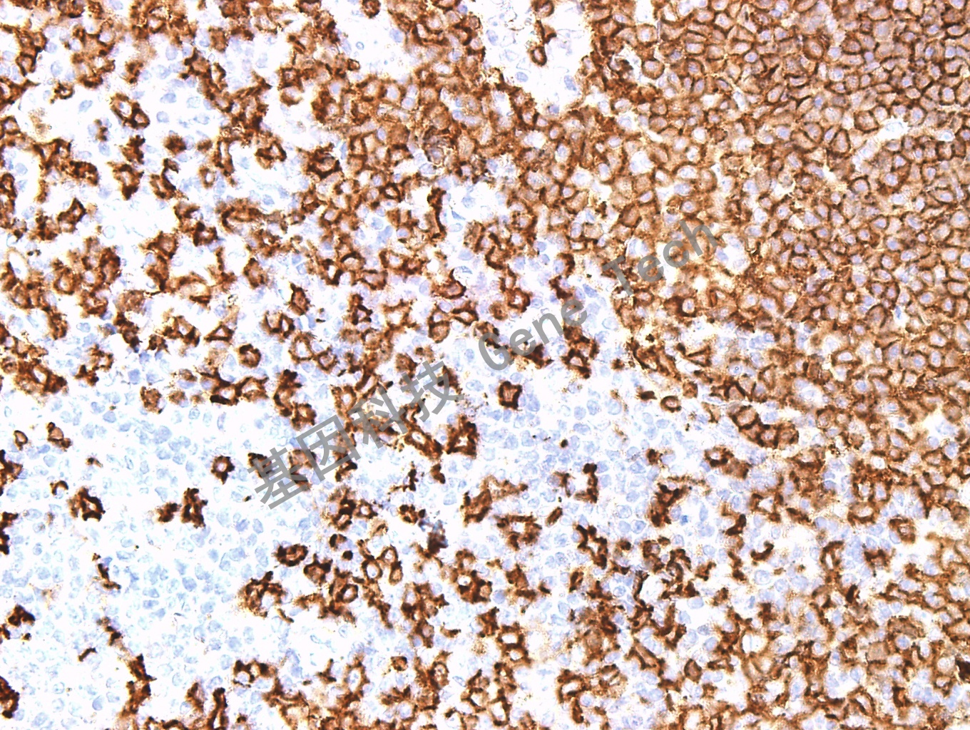 CD20 GM0755 Tonsil 40X_副本.jpg