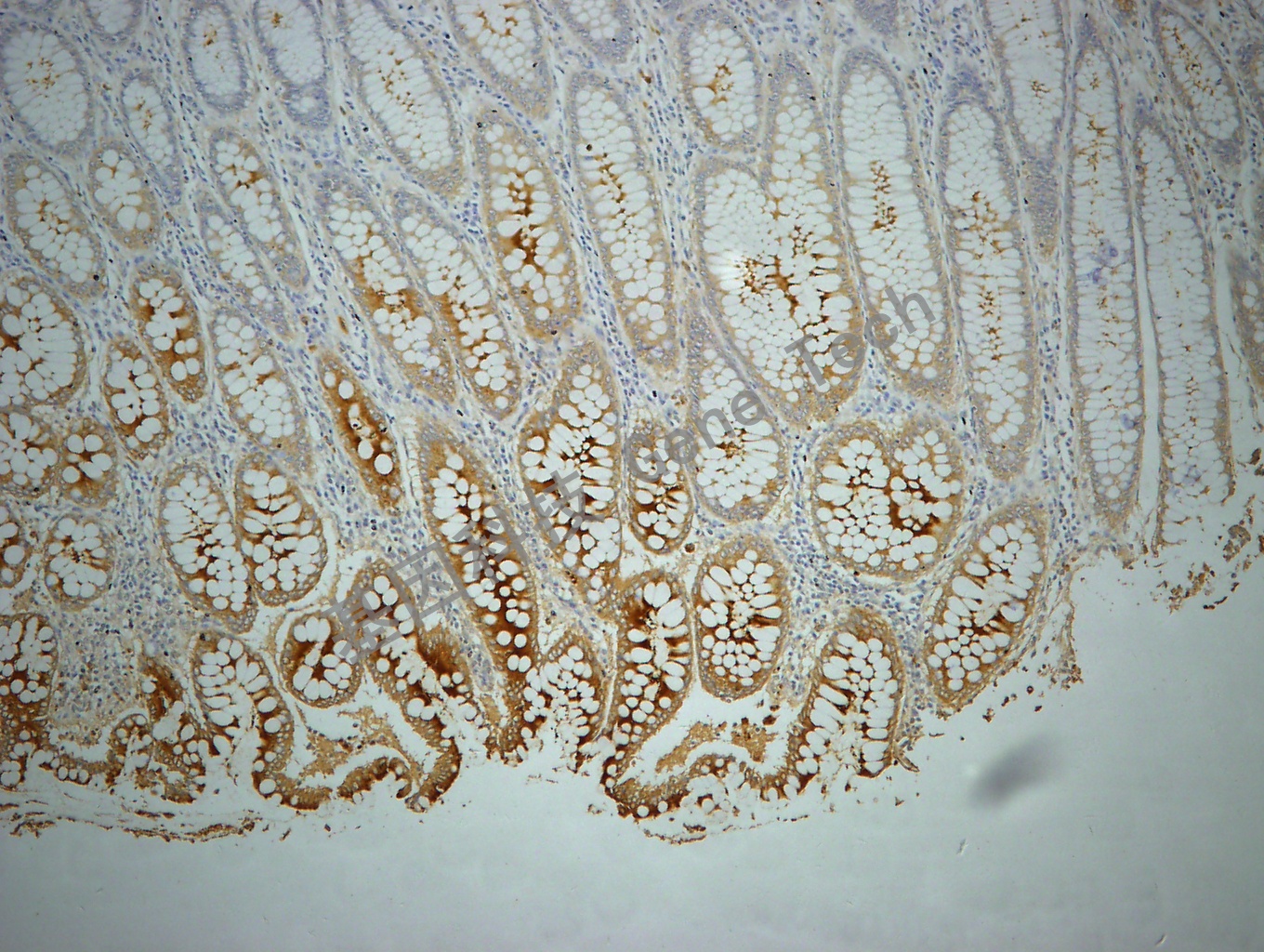 CEA GT2107 结肠癌 10X_副本.jpg