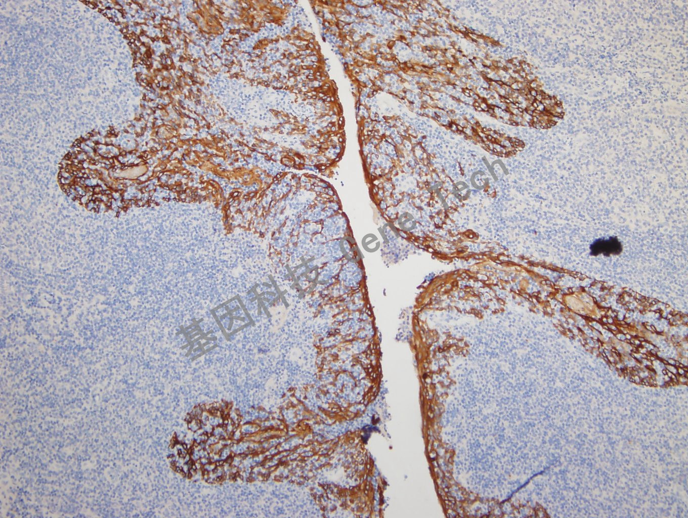 20180925-14 CKPAN-3 Tonsil_副本.jpg