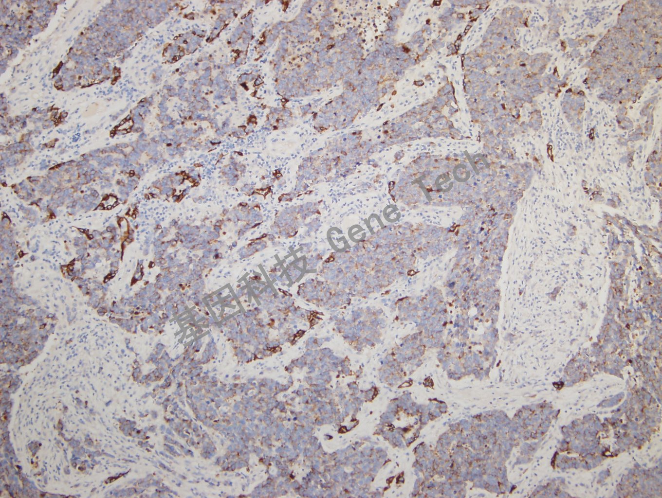 20180925-14 CKPAN-4  Small cell lung carcinoma_副本.jpg
