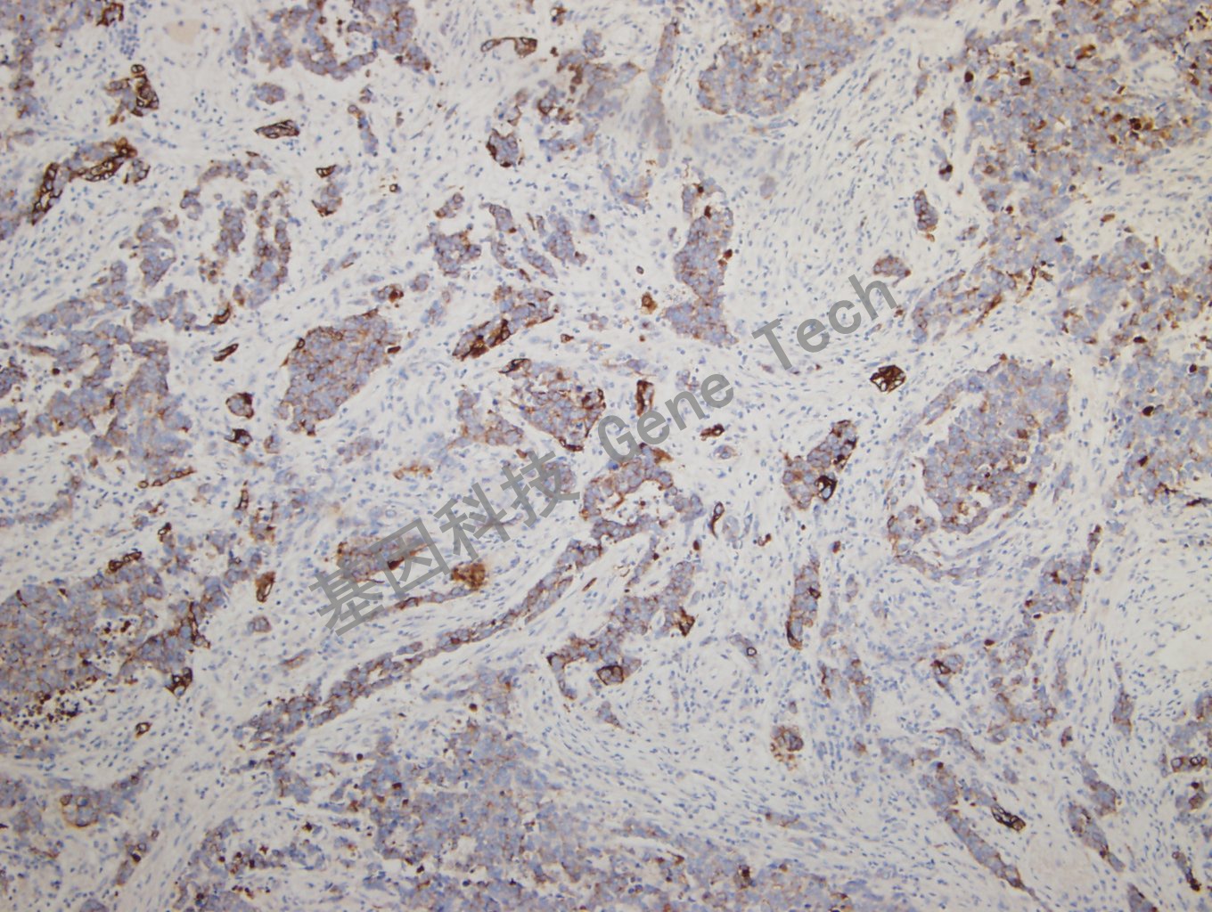 20180925-14 CKPAN-4  Small cell lung carcinoma2_副本.jpg