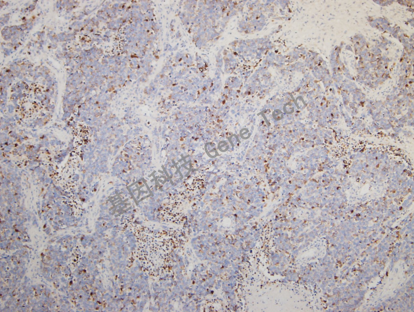 20180925-14 CKPAN-4  Small cell lung carcinoma3_副本.jpg