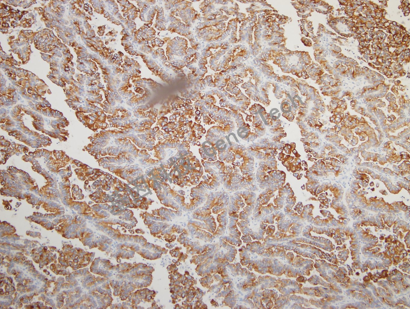 20180925-14 CKPAN-5 Lung adenocarcinoma_副本.jpg