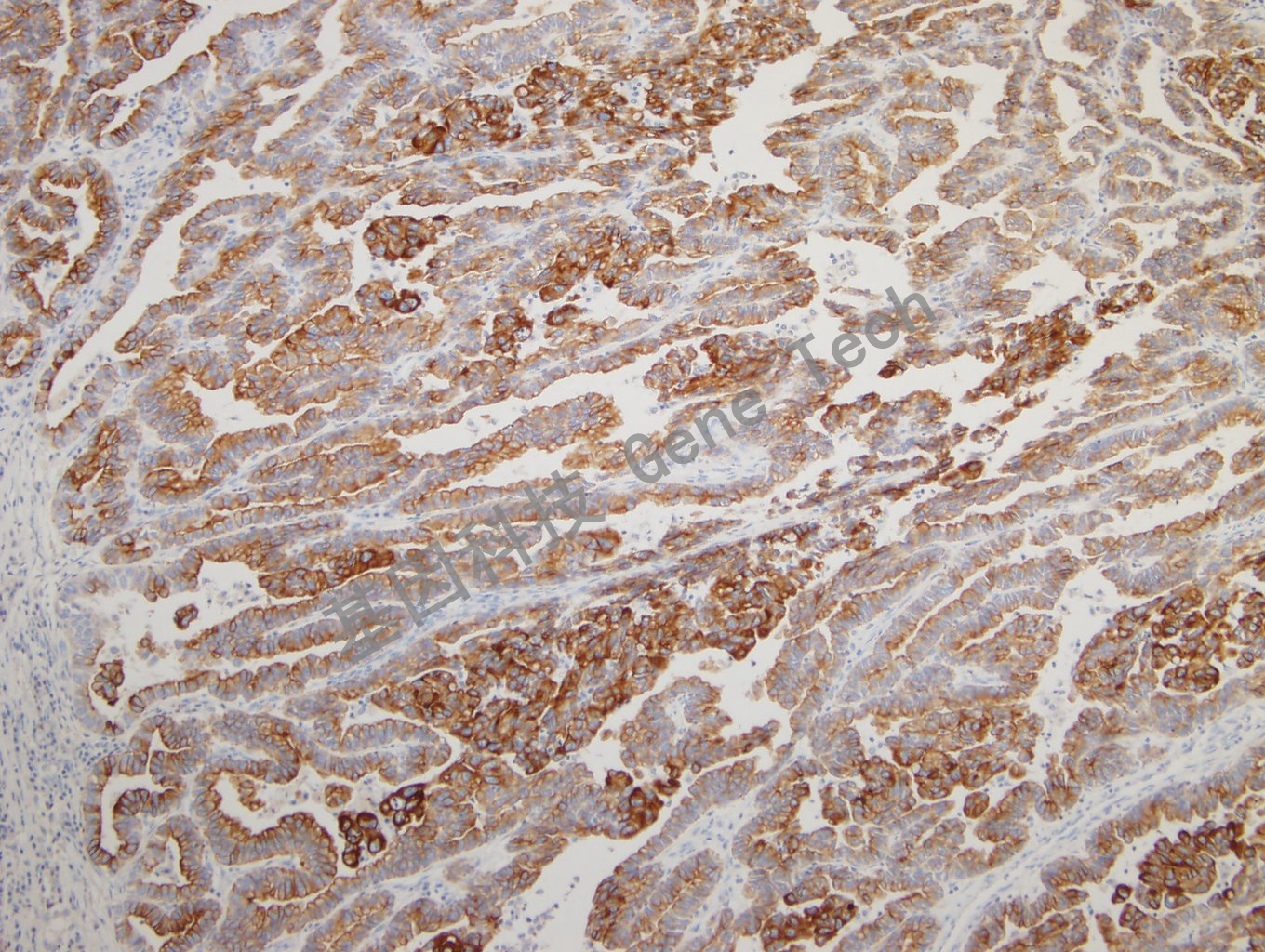 20180925-14 CKPAN-5 Lung adenocarcinoma3_副本.jpg