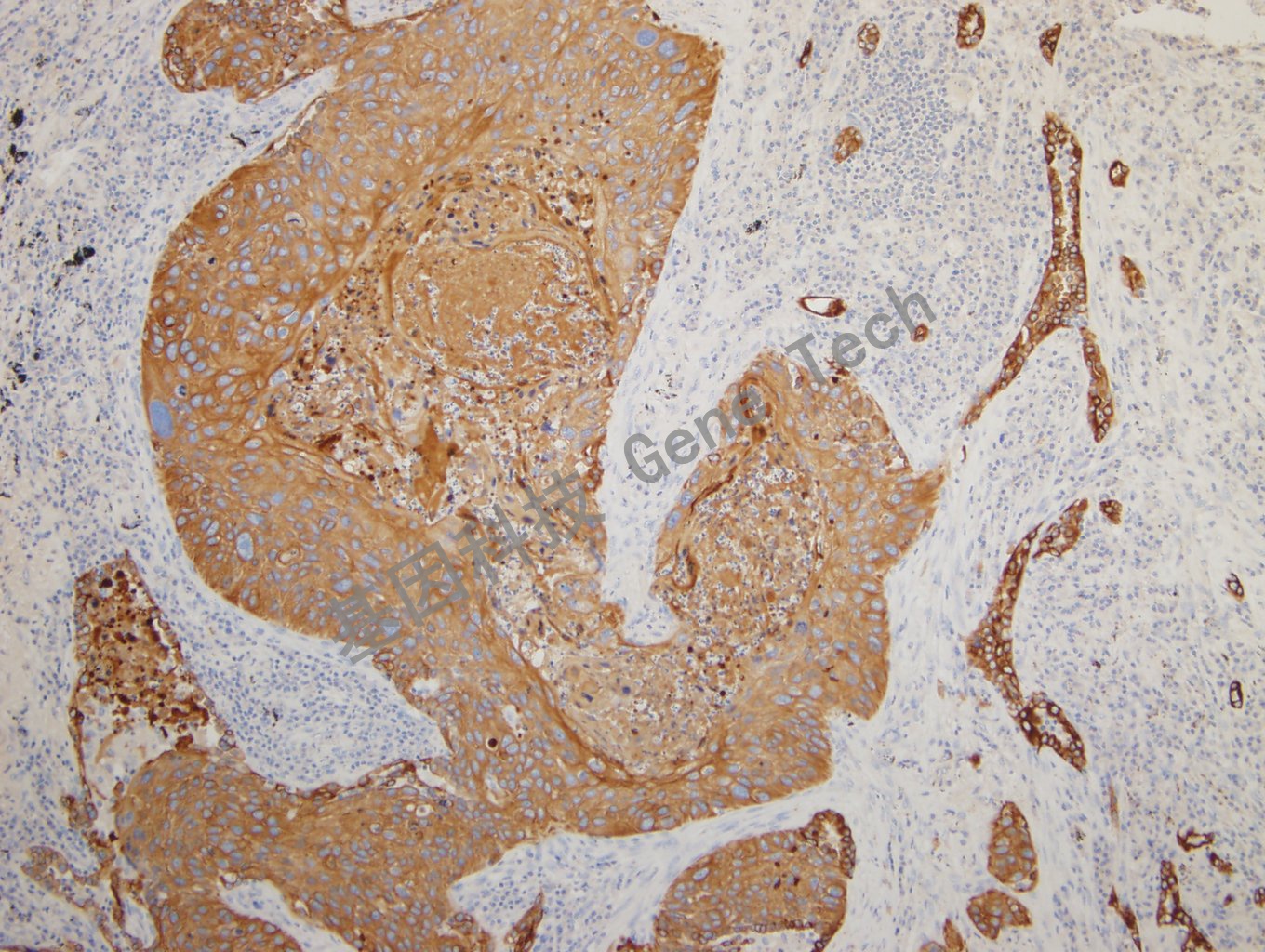 20180925-14 CKPAN-6  Lung squamous cell carcinoma_副本.jpg