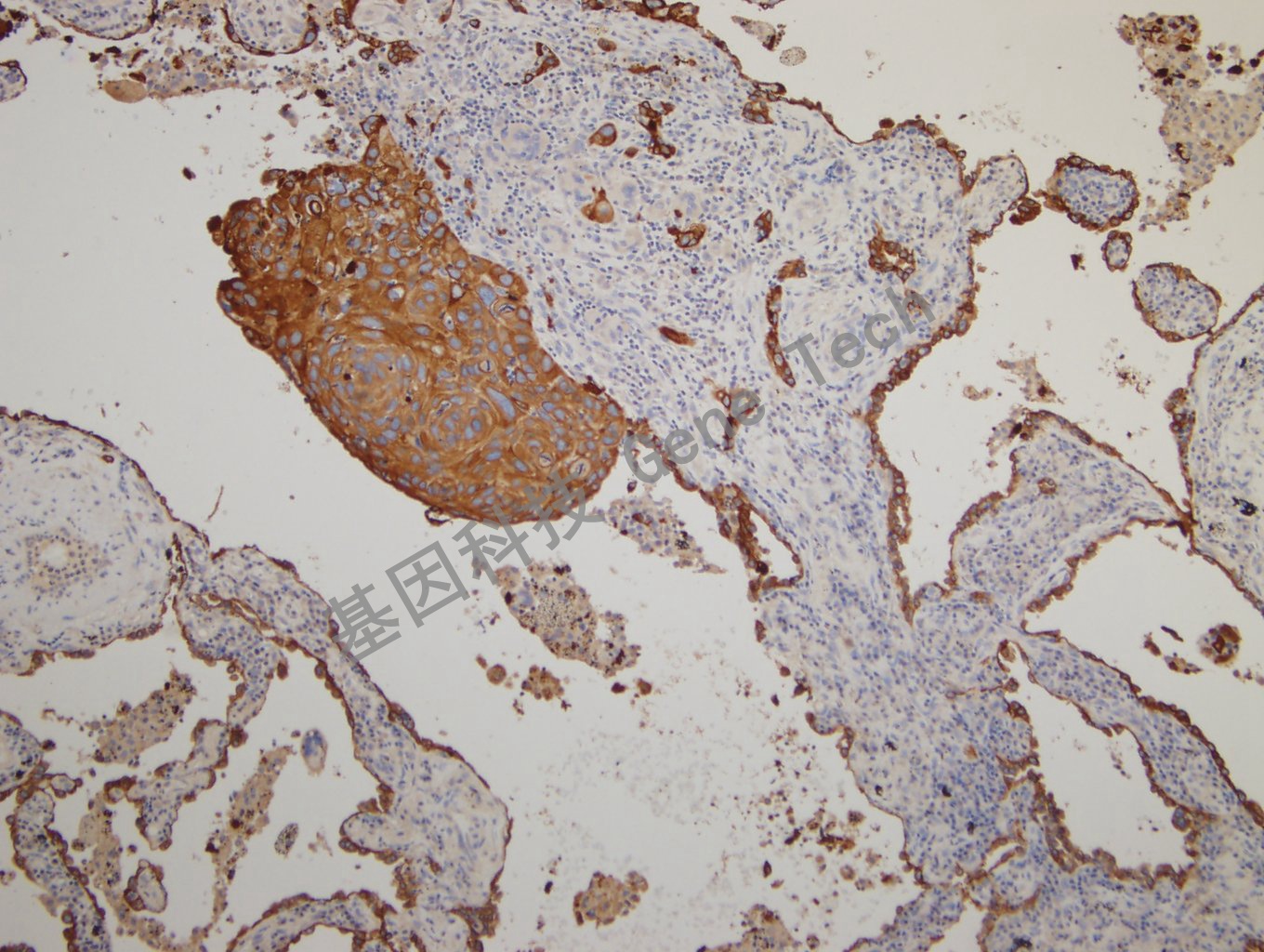 20180925-14 CKPAN-6  Lung squamous cell carcinoma2_副本.jpg