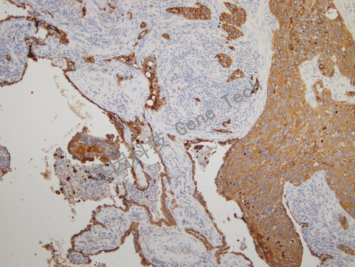 20180925-14 CKPAN-6  Lung squamous cell carcinoma3_副本.jpg