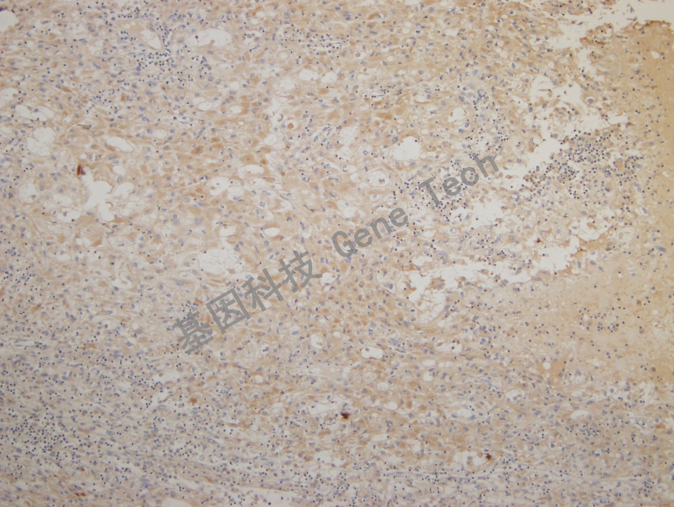 20180925-14 CKPAN-7 Renal clear cell carcinoma_副本.jpg