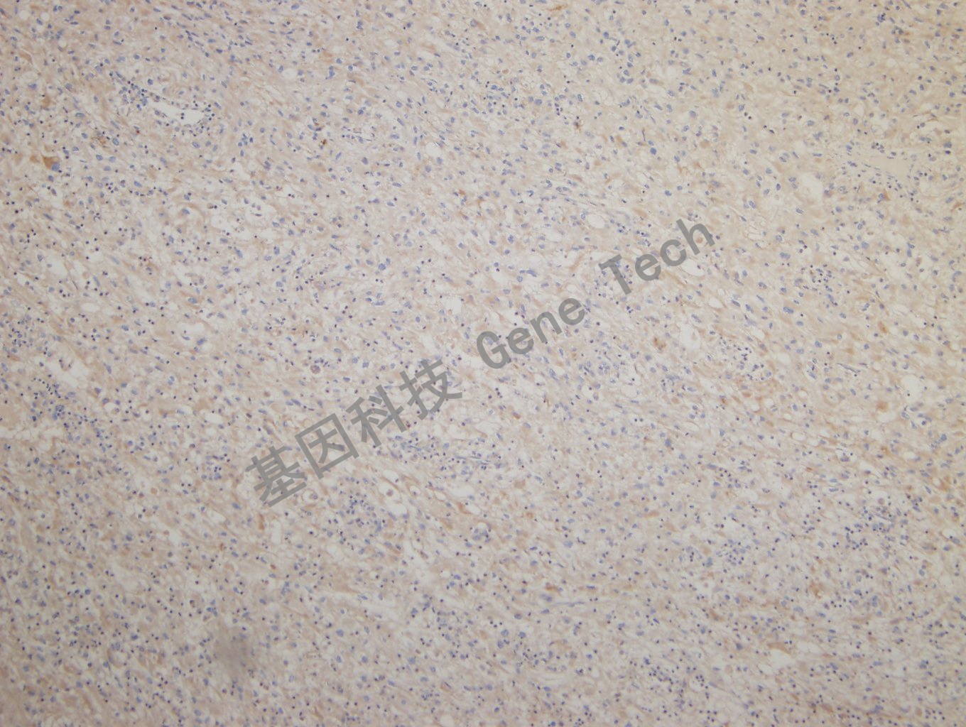 20180925-14 CKPAN-7 Renal clear cell carcinoma2_副本.jpg