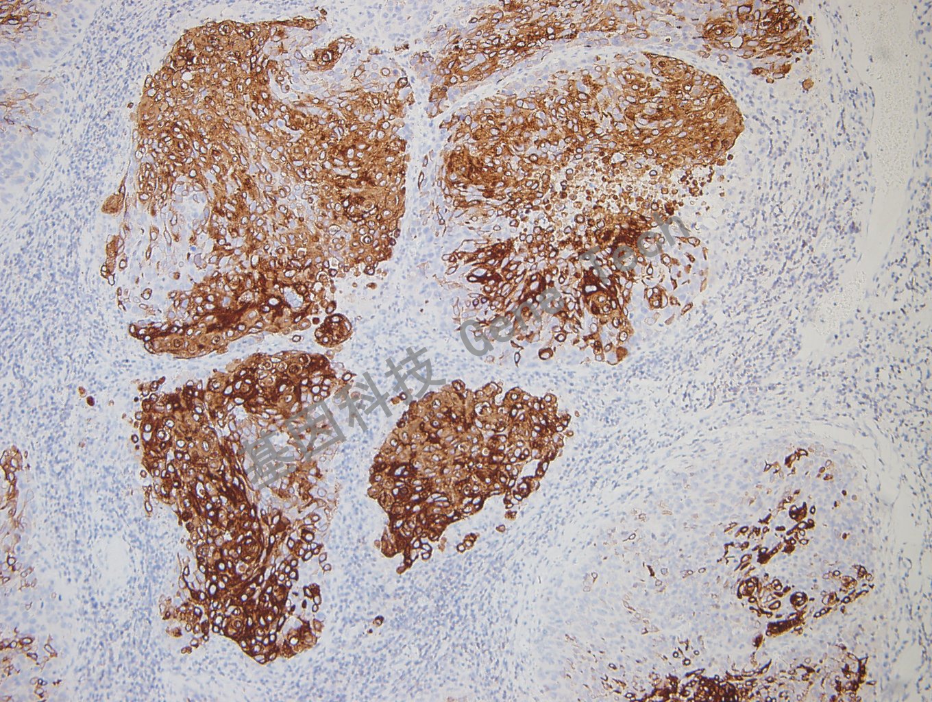 20180827-11 O6-2宫颈癌_副本.jpg