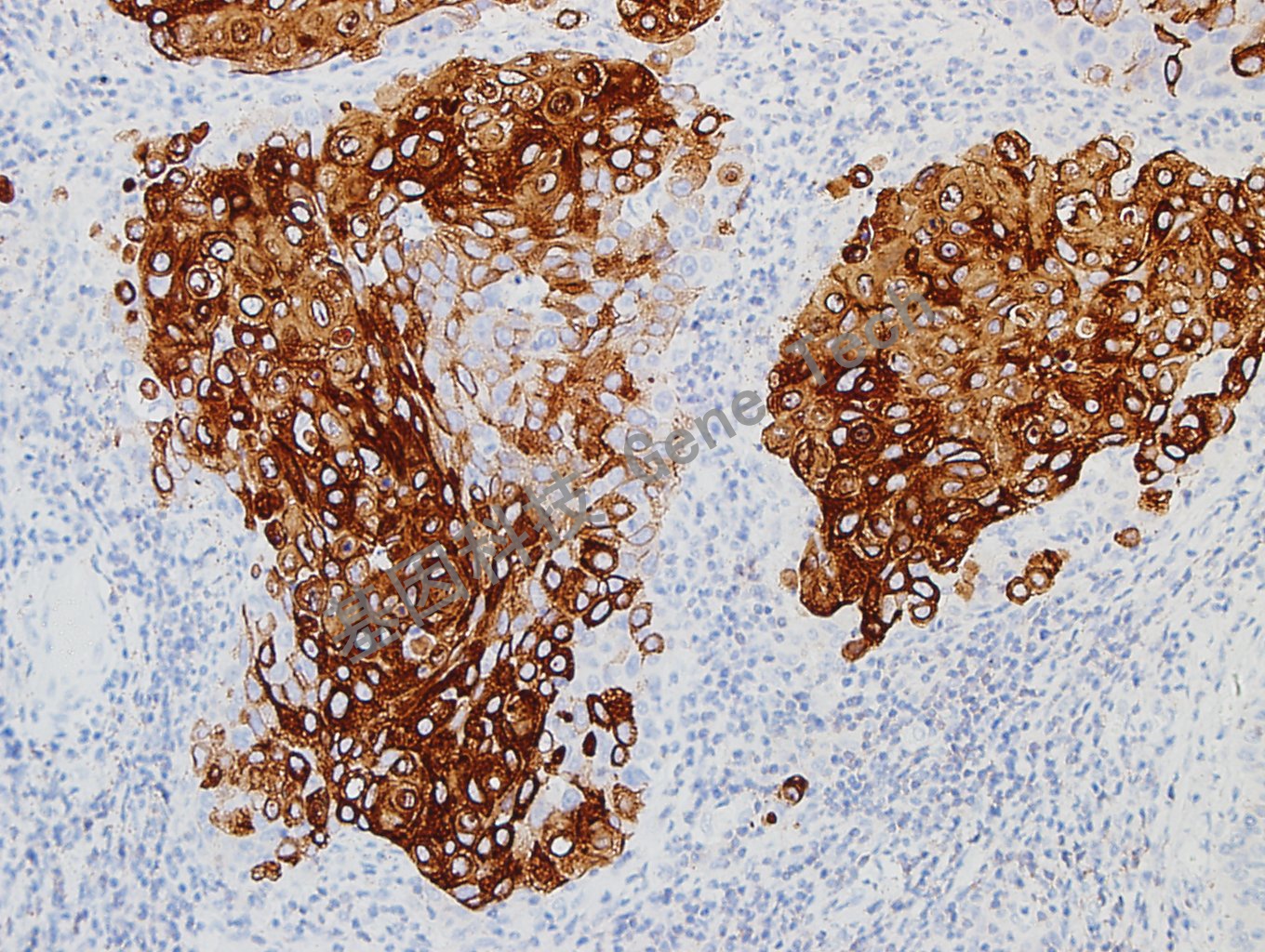 20180827-11 O6-3宫颈癌_副本.jpg