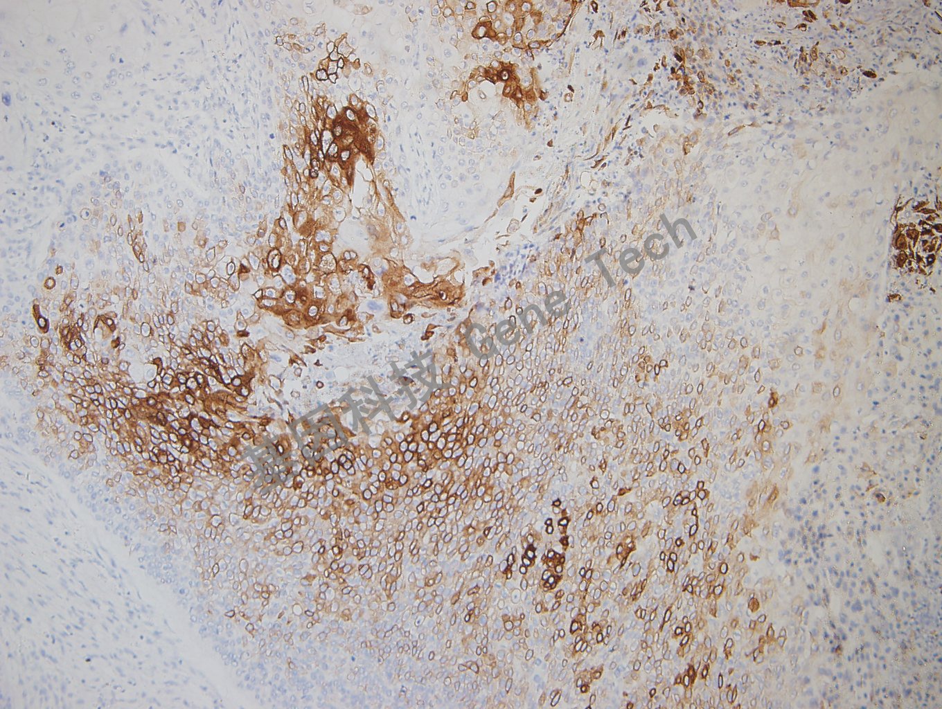 20180827-12 D2-1食管癌_副本.jpg