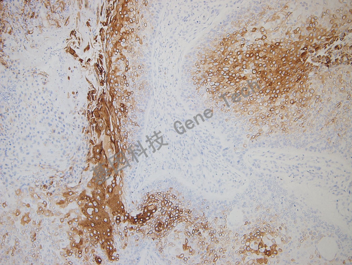 20180827-12 D2-2食管癌_副本.jpg