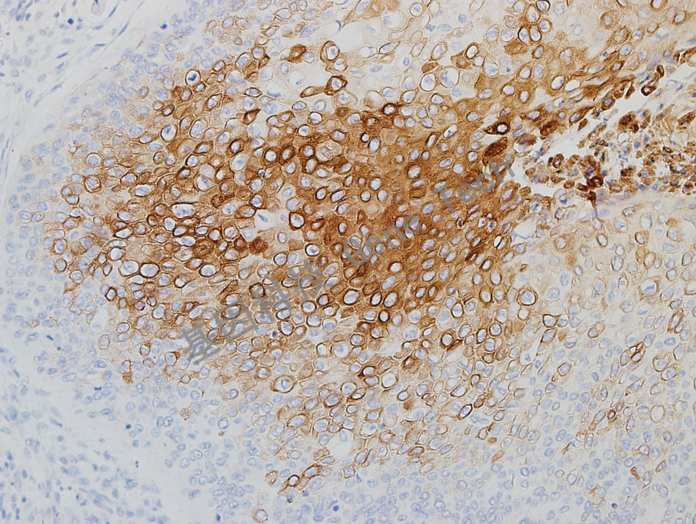 20180827-12 D2-3食管癌_副本.jpg