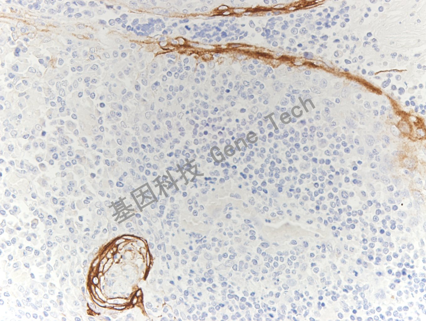 CK16 GT2228 扁桃体_副本.jpg