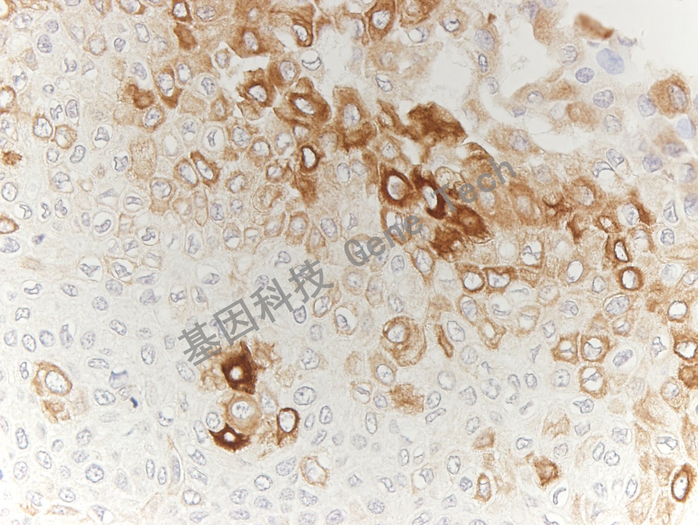 CK16 GT2228 食道癌_副本.jpg