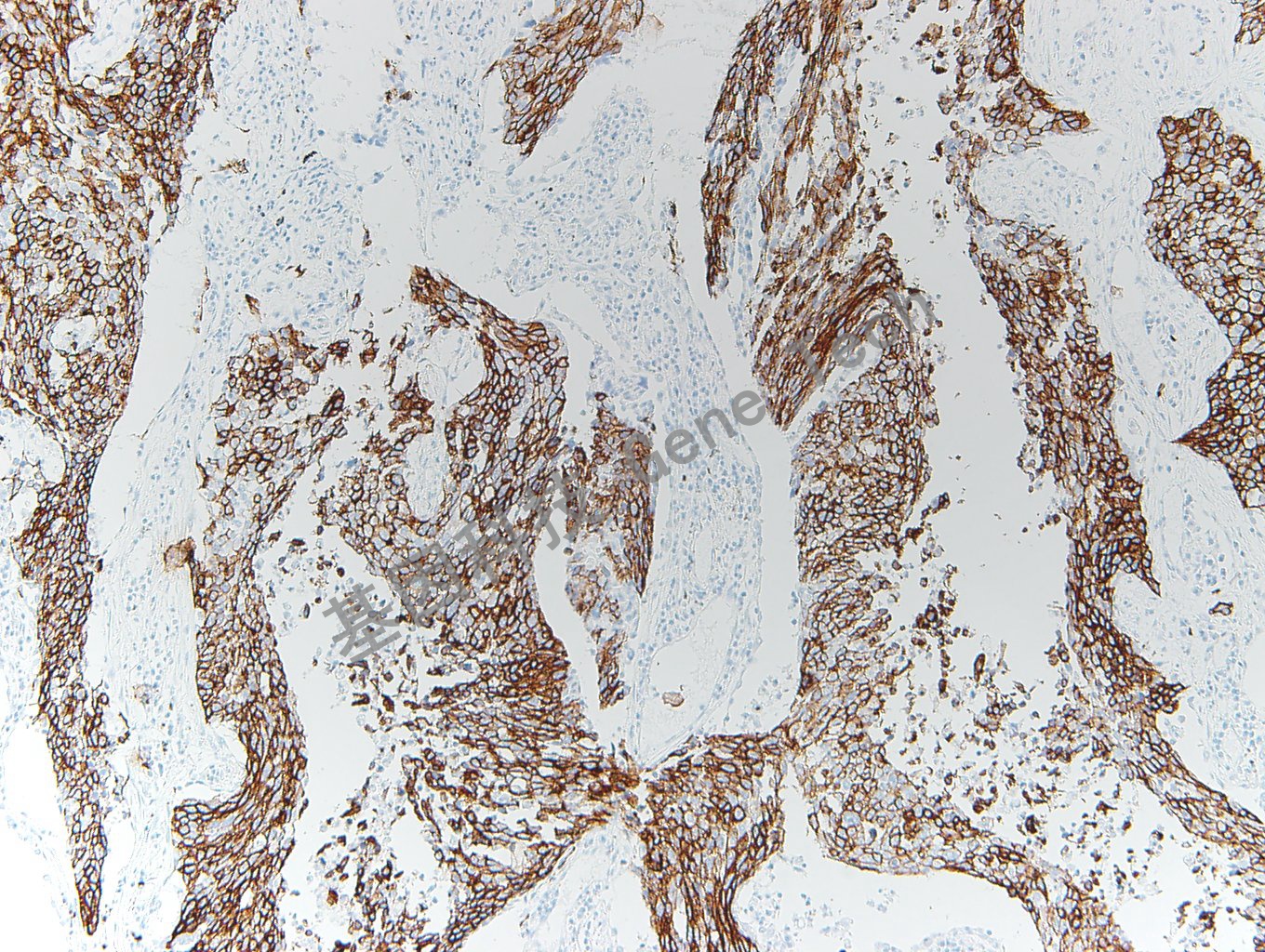 20200416-10 CK5 P63-T6 肺鳞癌_副本.jpg