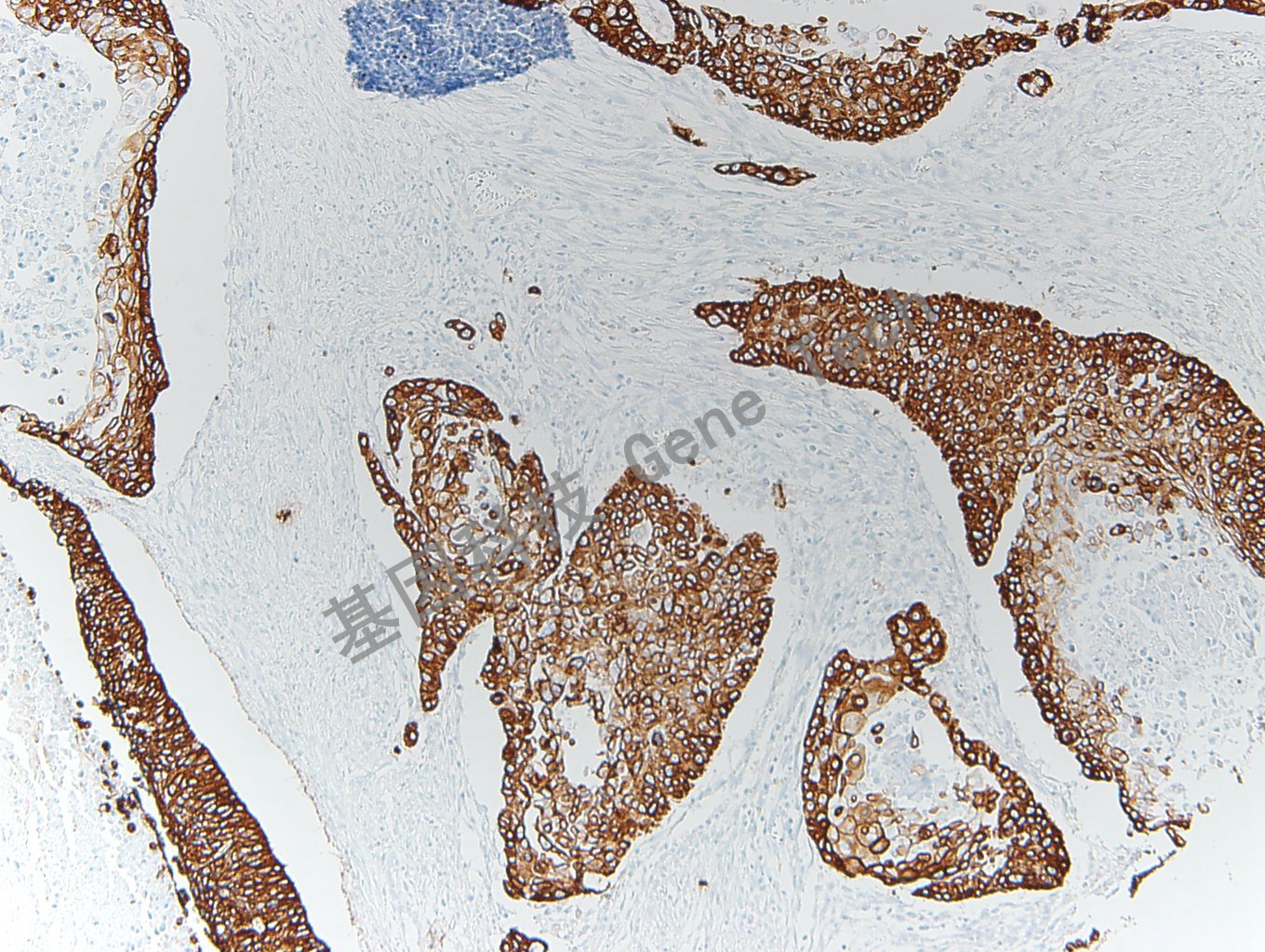 20200416-10 CK5 P63-T6 膀胱癌_副本.jpg