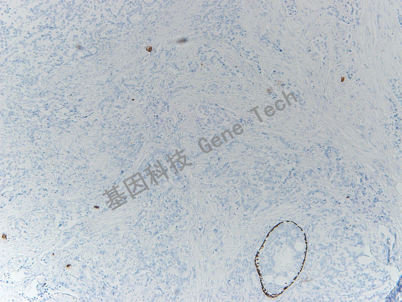 20200416-10 CK5 P63-T6 前列腺癌_副本.jpg