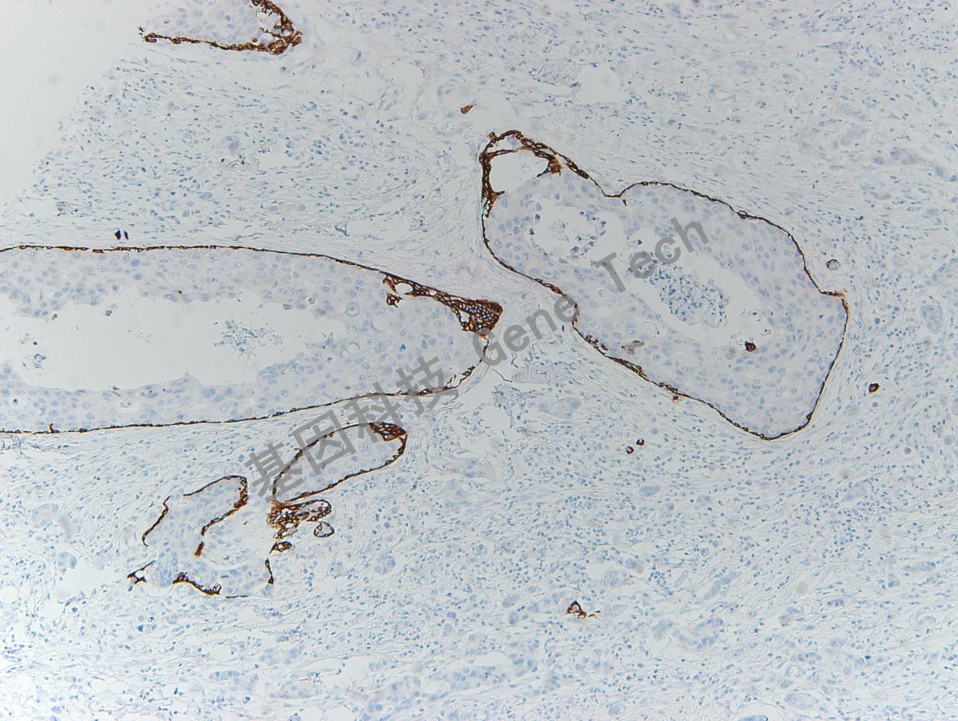 20200416-10 CK5 P63-T6 乳腺癌_副本.jpg