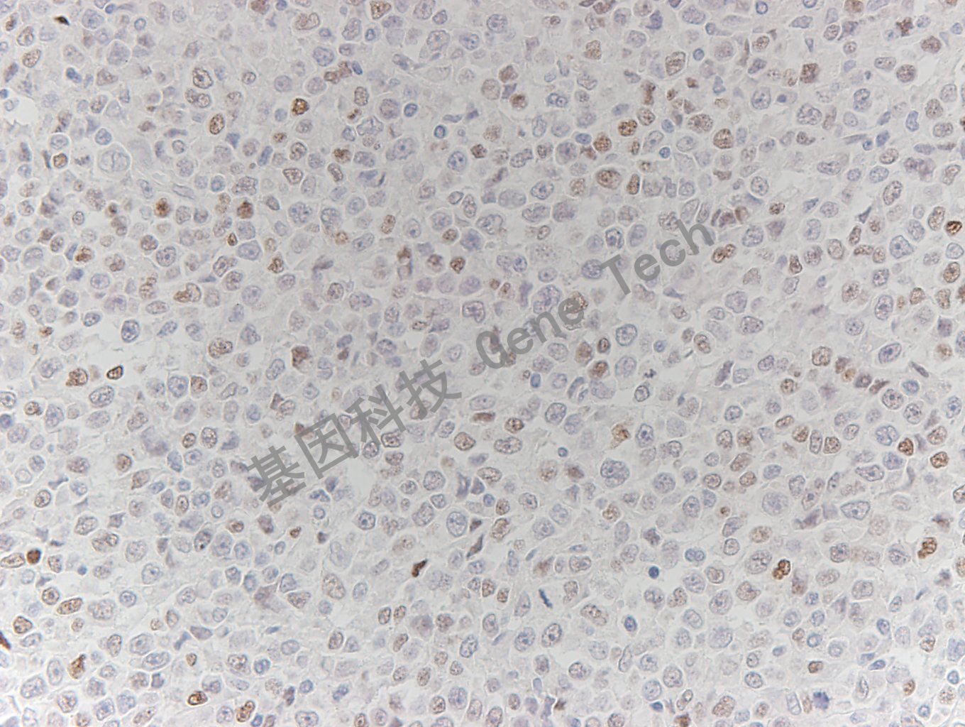 c-myc GT2206 弥漫性大B细胞淋巴瘤 40x_副本.jpg