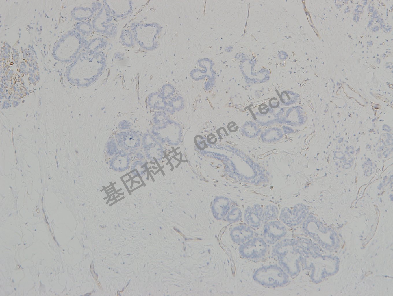 20190315-16 collagen IV C45 小叶原位癌-1_副本.jpg