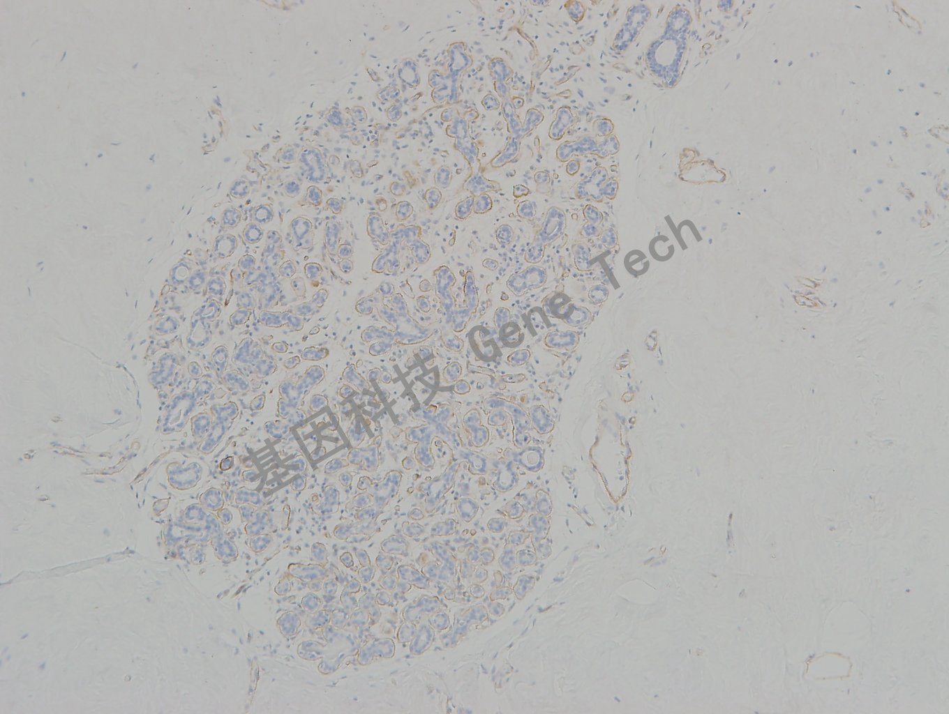 20190315-16 collagen IV C45 小叶原位癌-2_副本.jpg