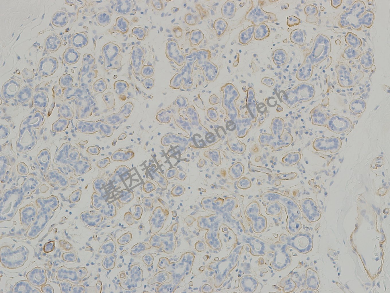 20190315-16 collagen IV C45 小叶原位癌-3_副本.jpg