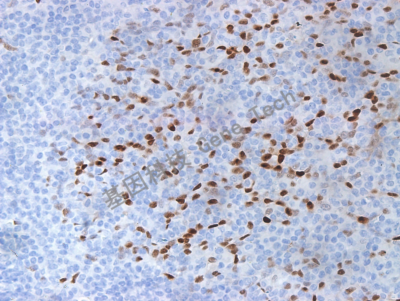 CyclinD1 GT2058 tonsil 40X_副本.jpg