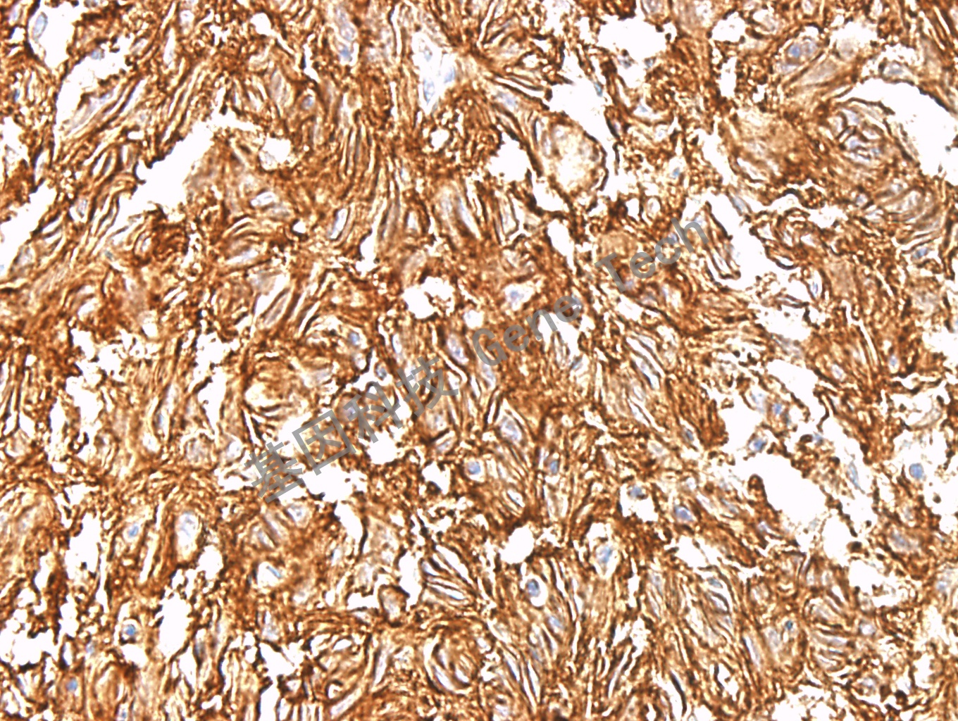 DOG1 GT2054 GIST 40X_副本.jpg