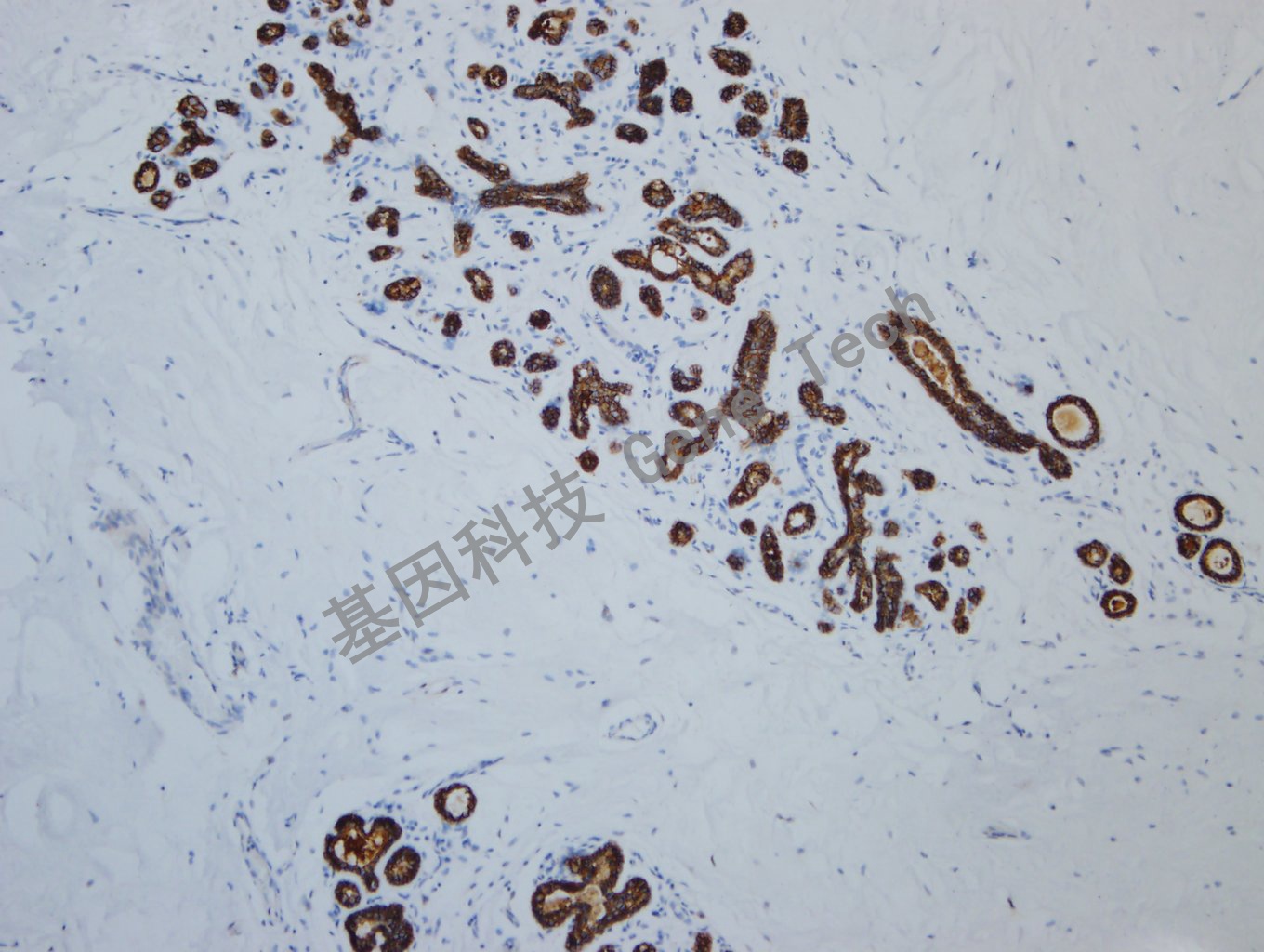 E-cad GT2107   乳腺癌 10X 20190917-40  -2_副本.jpg