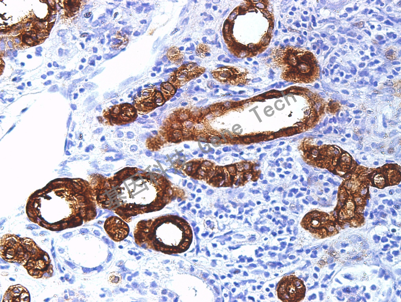 EMA GM0613 肾透明细胞癌40X _副本.jpg