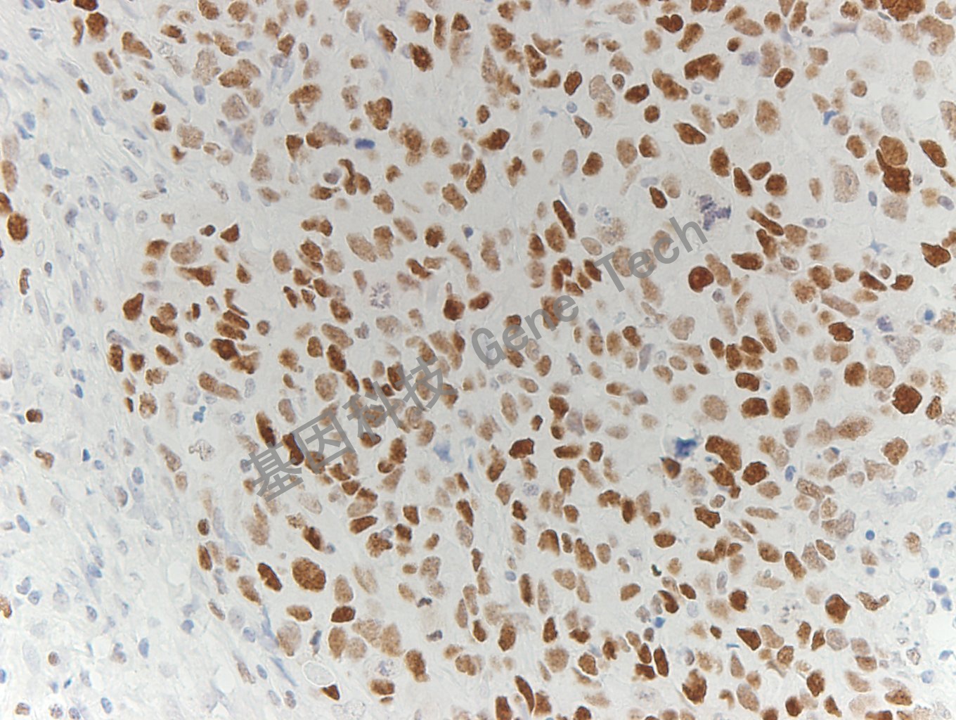 EZH2 GT2285 乳腺癌2_副本.jpg