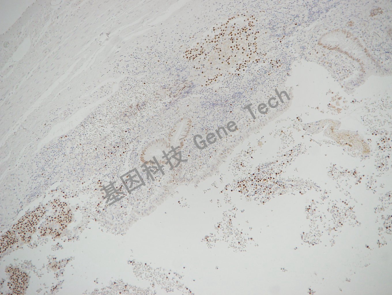 EZH2 GT2285-阑尾_副本.jpg