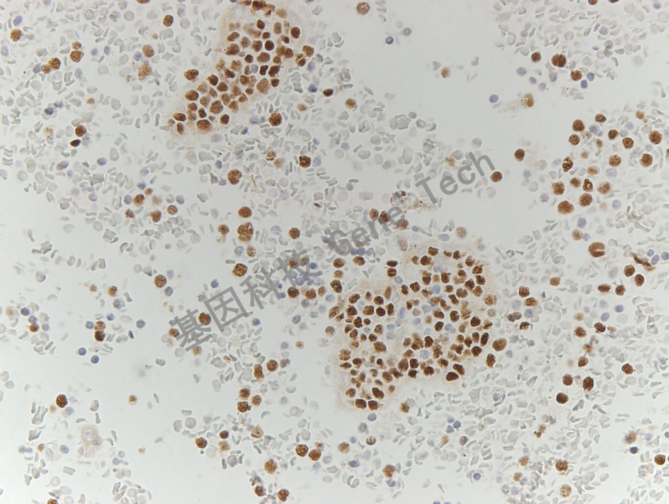 EZH2 GT2285-阑尾-炎症细胞_副本.jpg