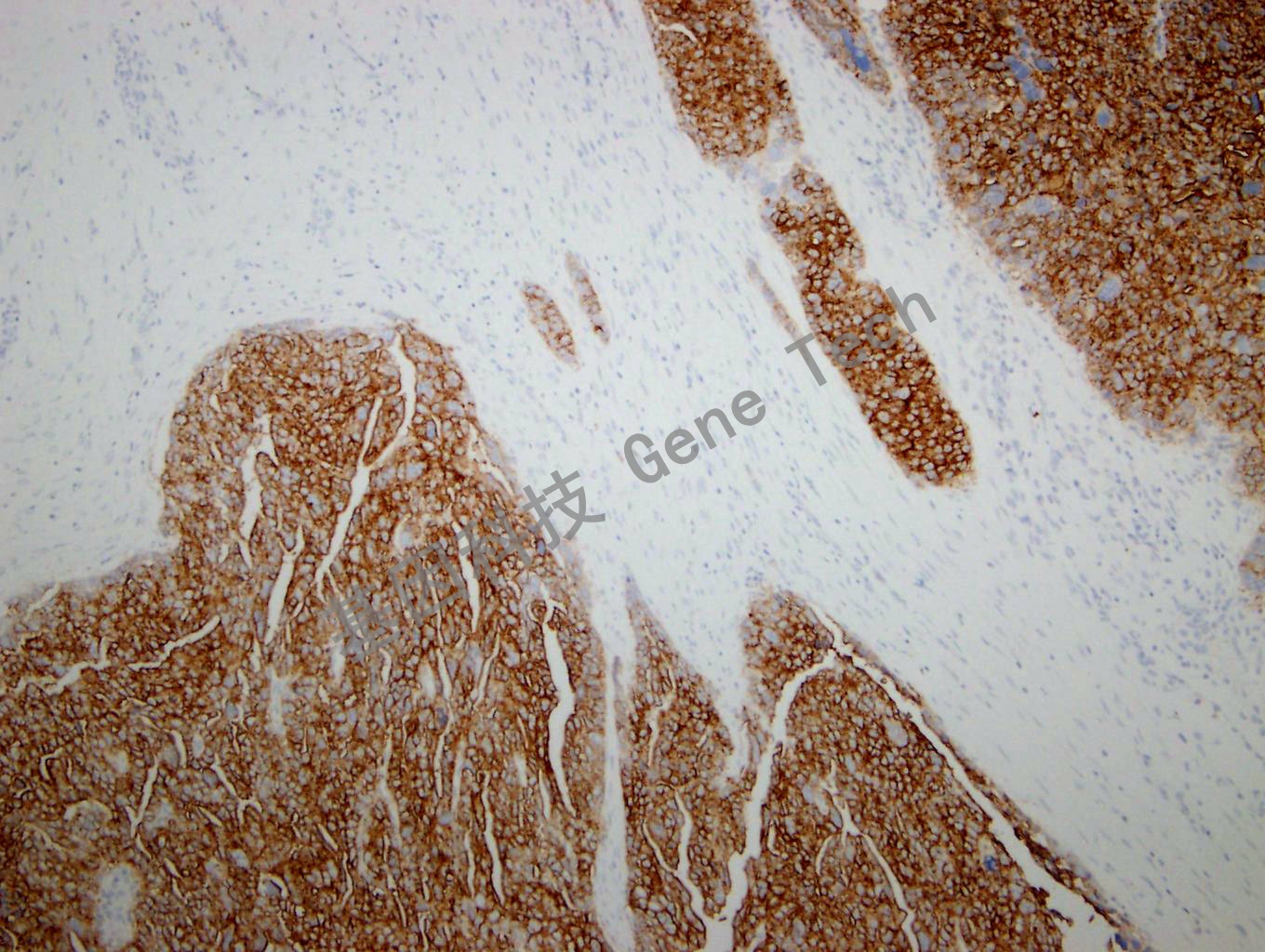 FRalpha GT2262 10X 卵巢癌1_副本.jpg