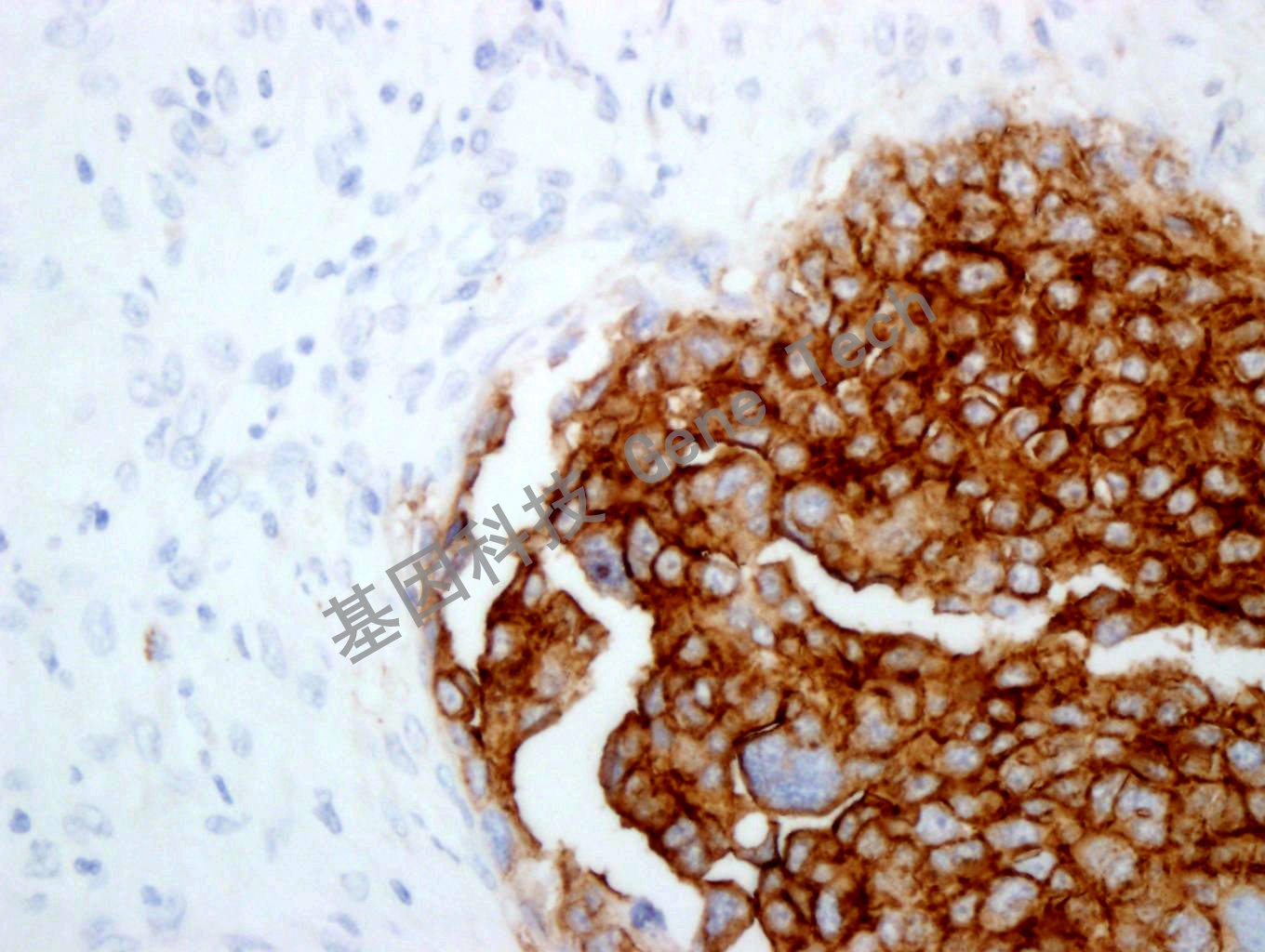 FRalpha GT2262 40X 卵巢癌_副本.jpg