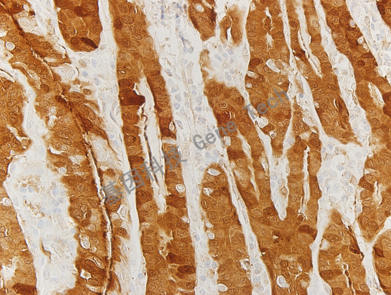 Galectin-3 GT2267 甲状腺 40X_副本.jpg