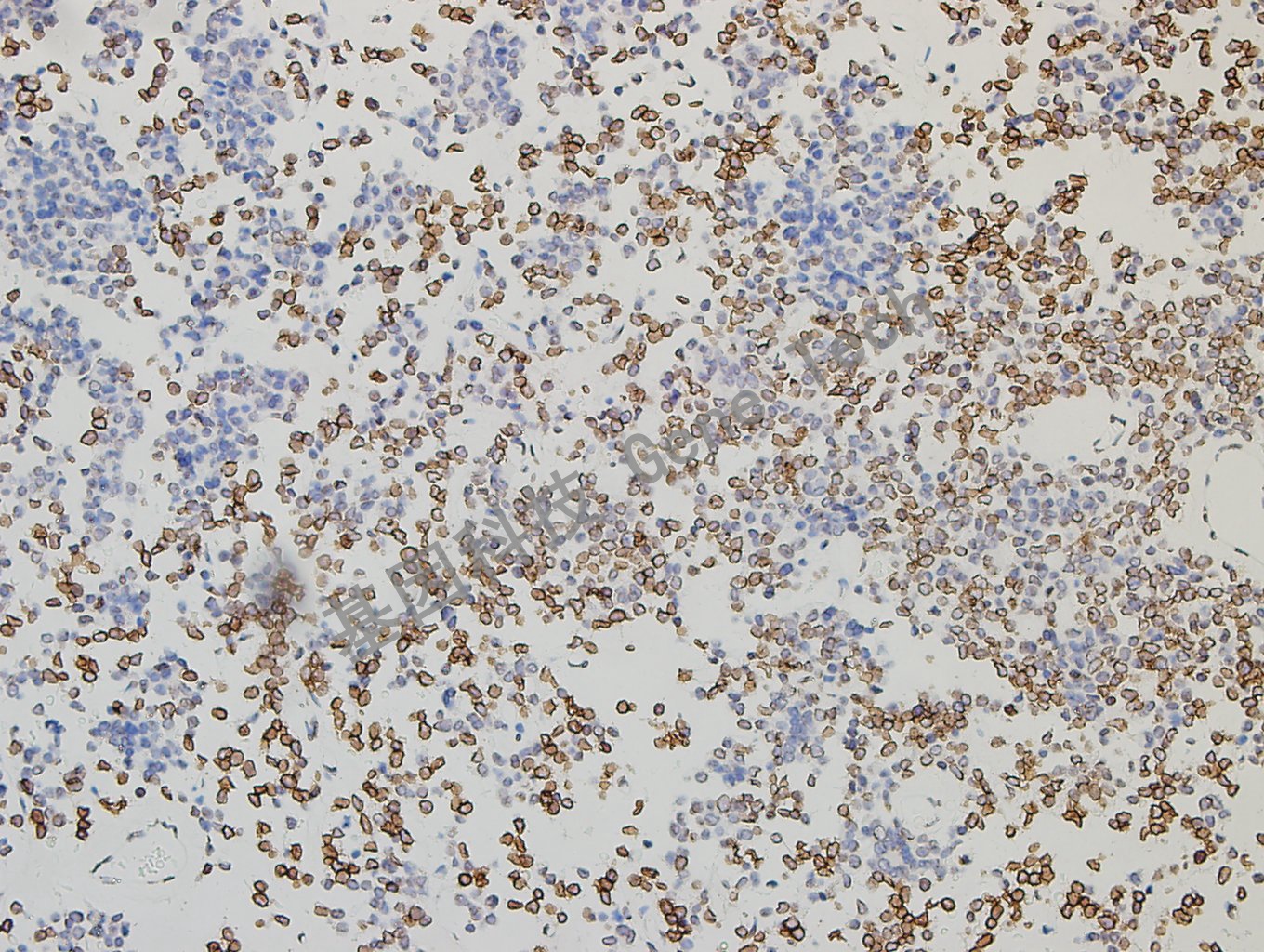 GATA2 垂体腺瘤-2_副本.jpg