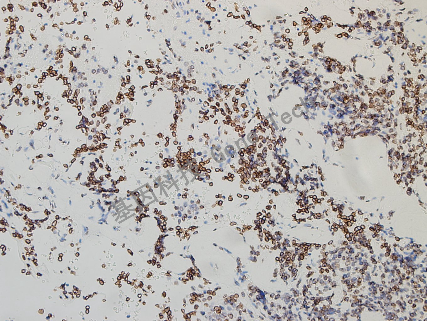 GATA2 垂体腺瘤-3_副本.jpg