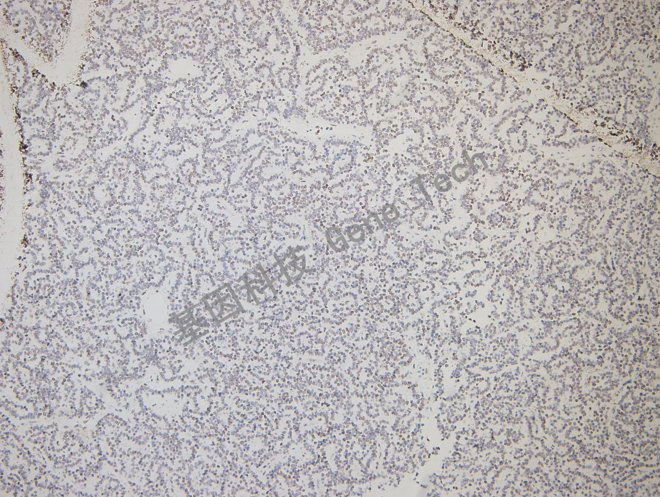 GATA2 垂体腺瘤-4_副本.jpg