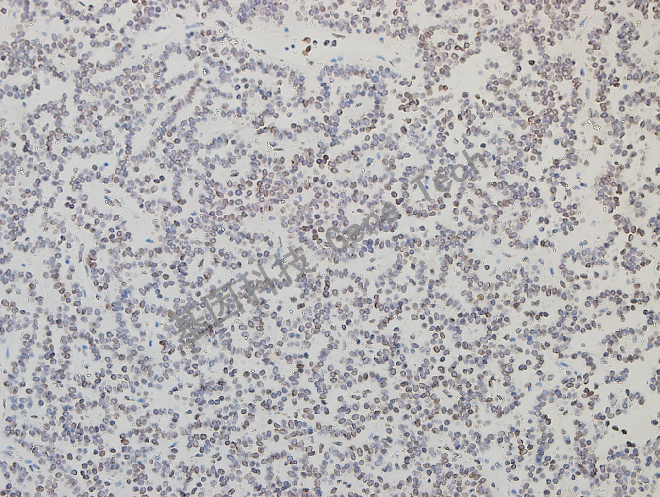 GATA2 垂体腺瘤-5_副本.jpg